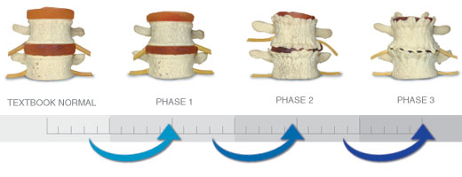 Phases of Spinal Degeneration